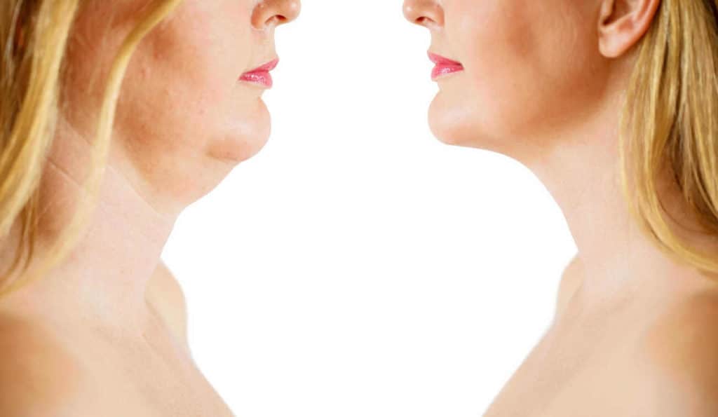 Double Chin treatment Chipping Norton before and after results