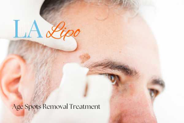 What Are the Most Effective Treatments for Age Spots Chipping Norton?