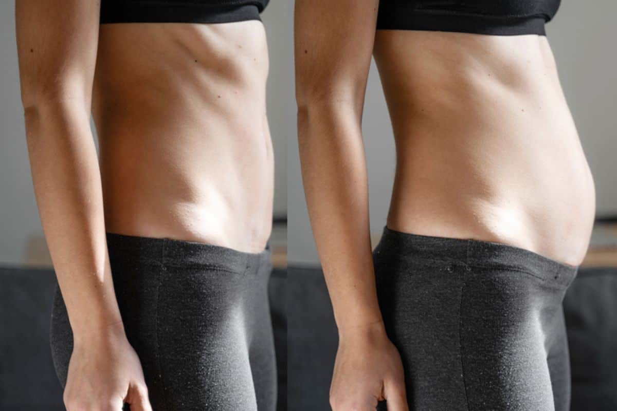How long does diastasis recti take to improve Chipping Norton?