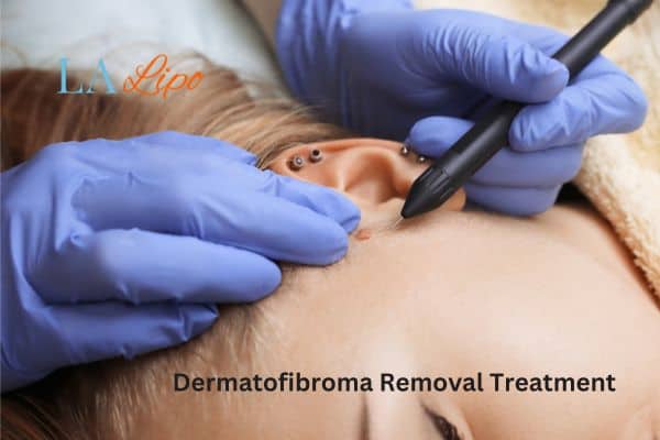 Dermatofibroma Removal Treatment Chipping Norton
