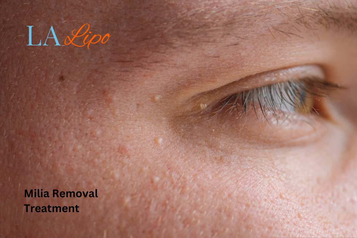 Cryopen Milia Removal: Is It the Easiest and Safest Option Chipping Norton?