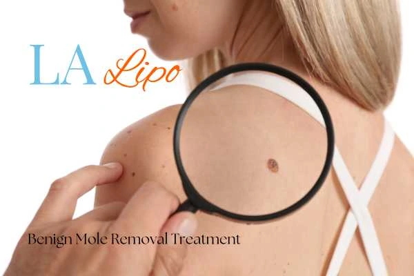 Why getting moles removed Chipping Norton can boost your confidence!