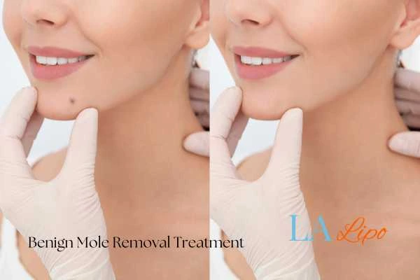 Woman's before and after results of being moles removal treatment Chipping Norton