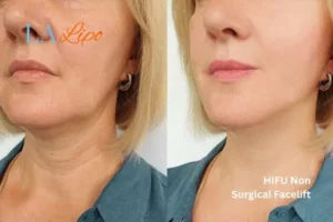 hi-fu for wrinkles Chipping Norton before and after results