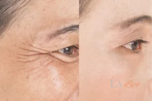 Before and after results of woman - HI-fu wrinkles reduction treatment Chipping Norton