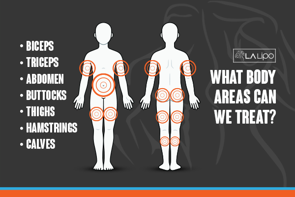 Graphic to show areas you can have LA-EMS Body Sculpting Chipping Norton treatment.