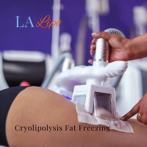 fat freezing - Cryolipolysis Chipping Norton