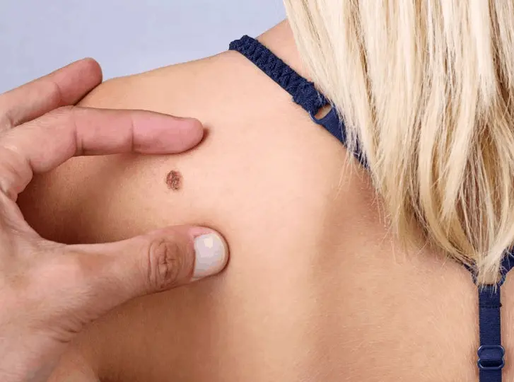 woman having mole removal Chipping Norton consultation before treatment.