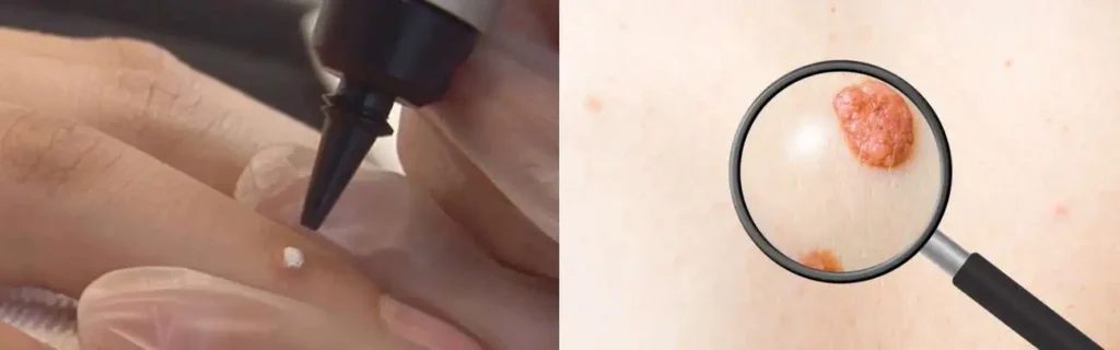 Cryopen for mole removal Chipping Norton - speak to our team today!