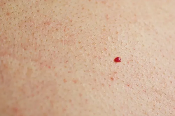 close up of a cherry angioma Chipping Norton