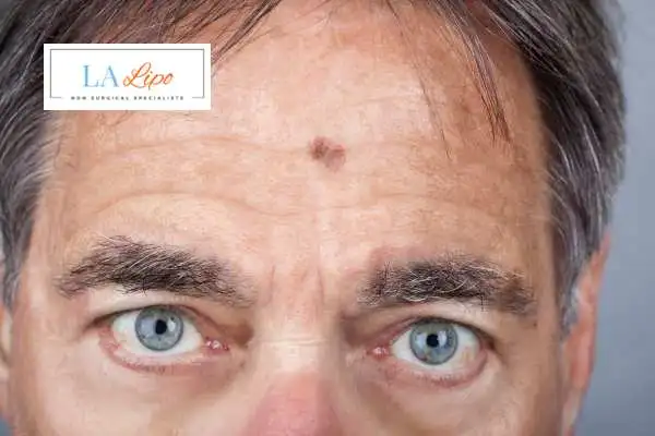 Solar Lentigo Removal Chipping Norton image of man with mark on his forehead