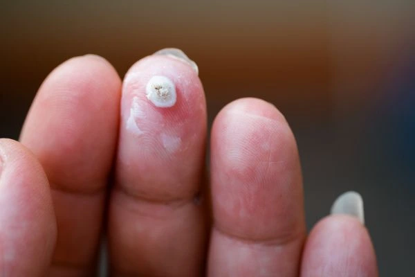 wart on person finger - cryotherapy to treat from LA LIPO Chipping Norton