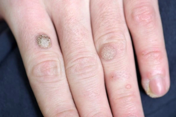 photo of warts on person hand - see wart removal Chipping Norton from LA LIPO