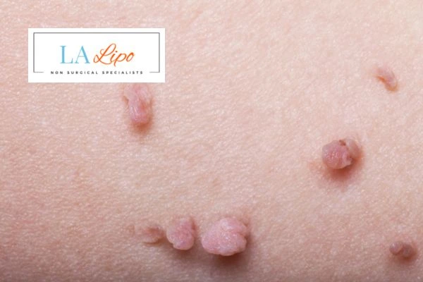 Does cryopen skin tag removal Chipping Norton hurt? Find out now call our team today!