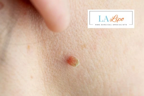 Book skin tag removal Chipping Norton today speak to our team now!