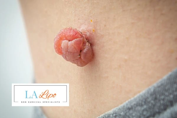 Interested in skin tag removal Chipping Norton? Concerned about the pain? Find out more today!