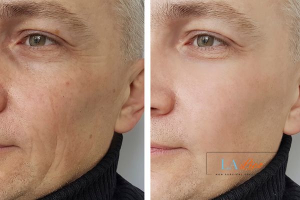 See the amazing results of Morpheus8 Treatment Chipping Norton!