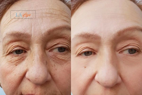 The powerful benefits of Morpheus8 Treatment Chipping Norton - Call Our team today!
