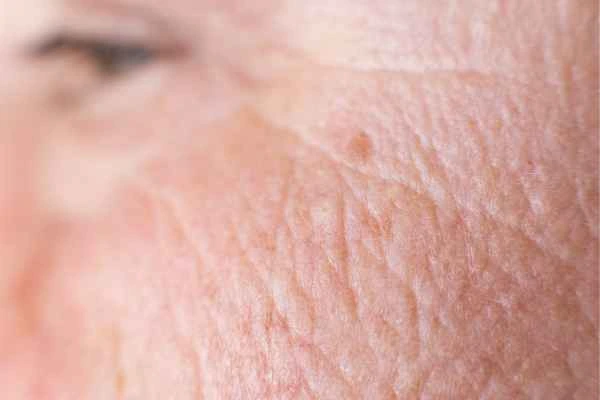 close up picture of a woman's face showing an age spot Chipping Norton