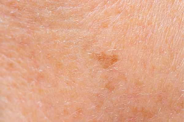 close up picture of age spots Chipping Norton