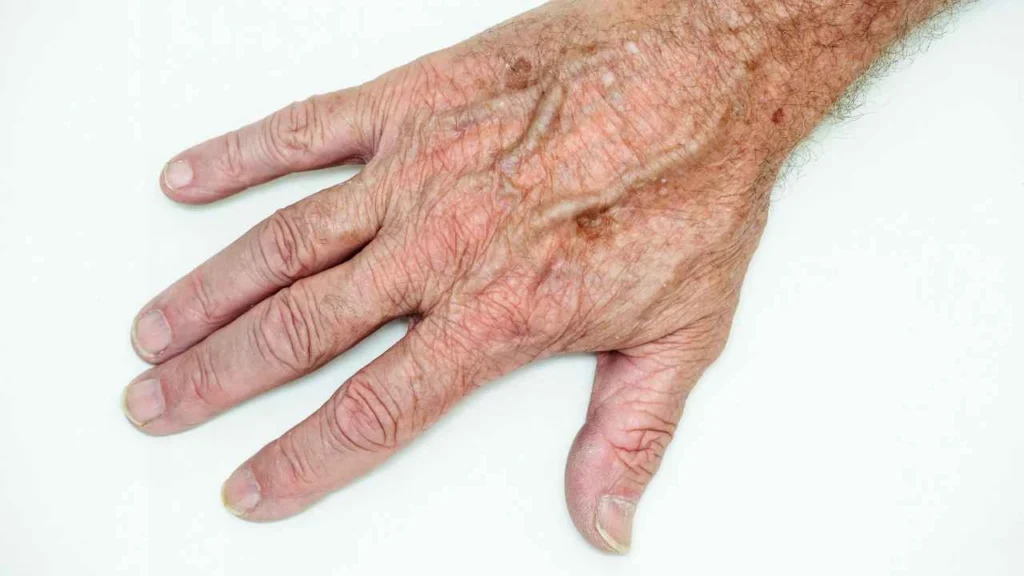 Male hand showing age spot Chipping Norton
