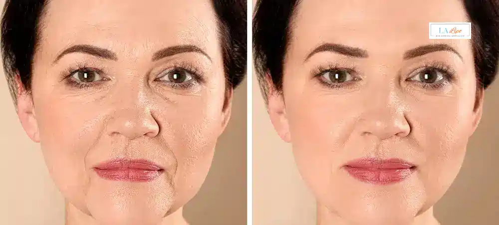 How Long Does It Take to See Results and How Long Do They Last Chipping Norton?