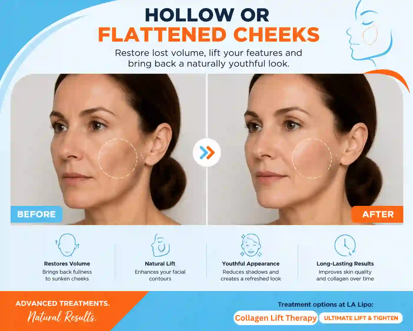 Sign #4: Hollow or Flattened Cheeks Chipping Norton